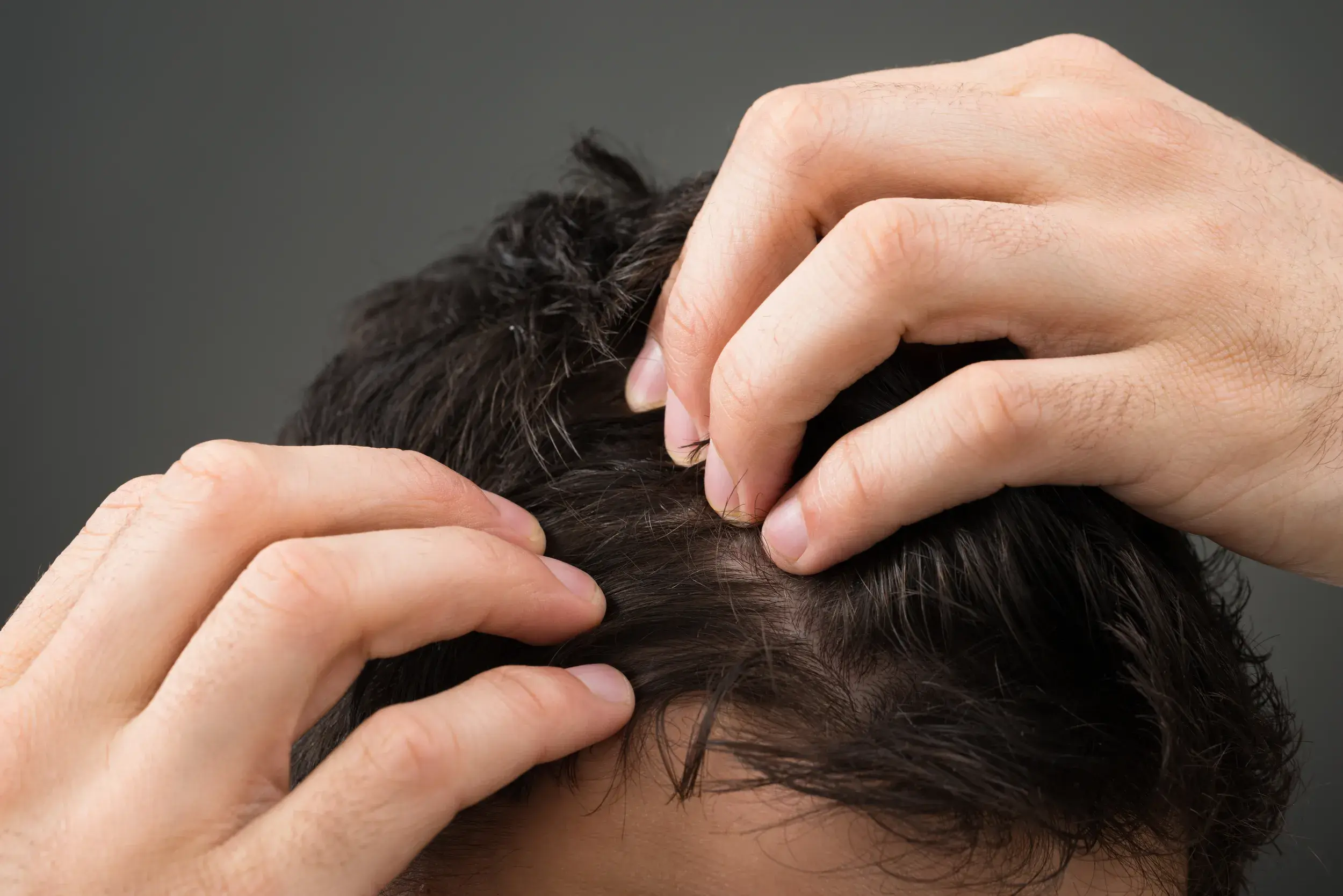 brunette man parting his hair with fingers to reveal scalp