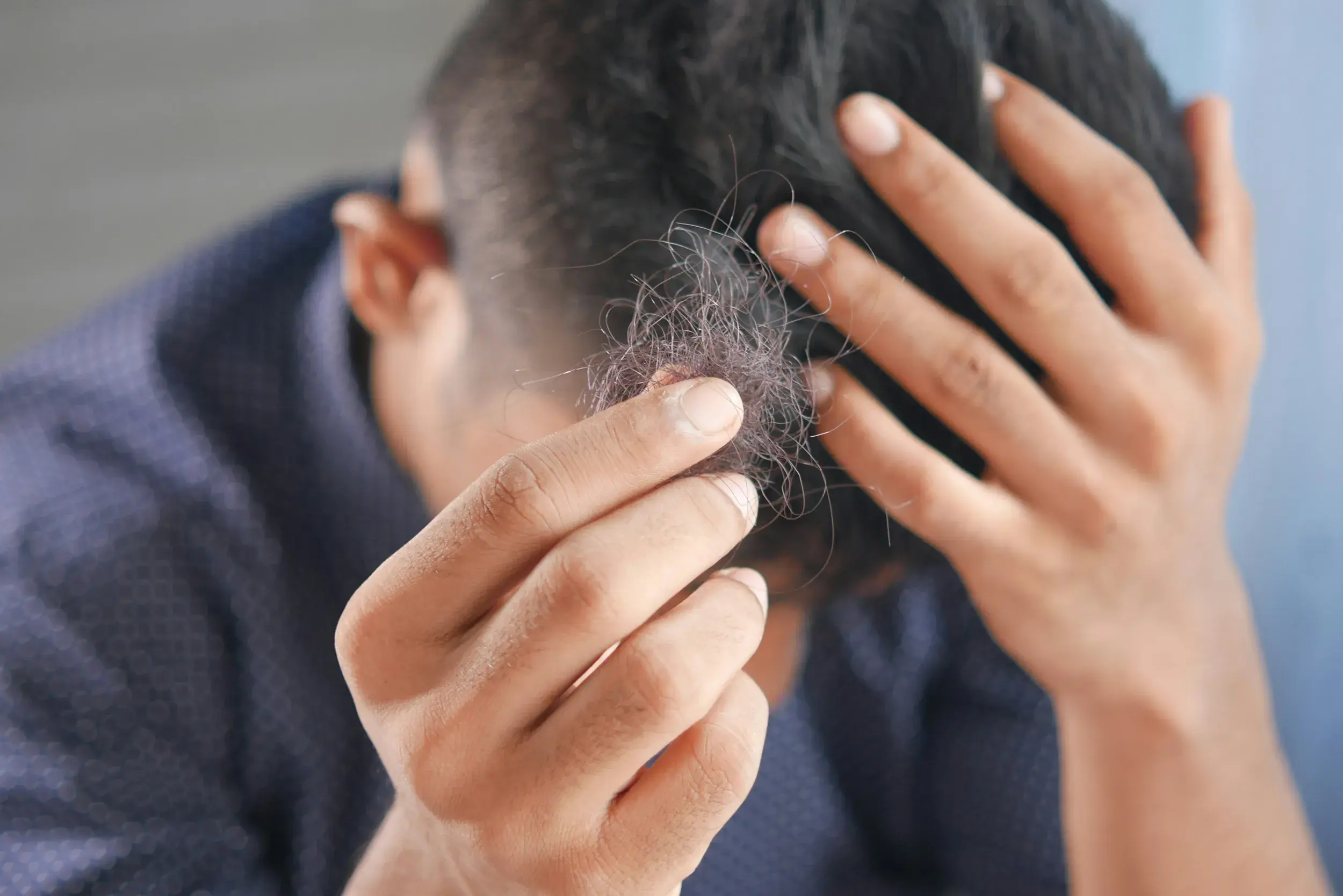 A young man sits with his head in his hand holding up a clump of brown hair