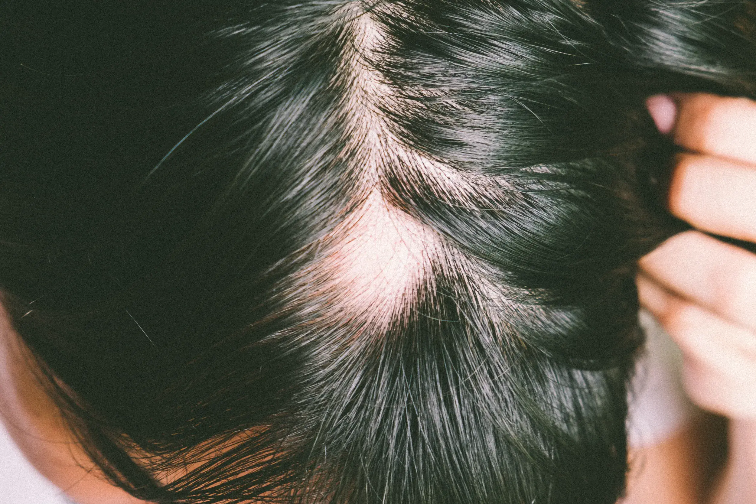 ALOPECIA BALD PATCHES