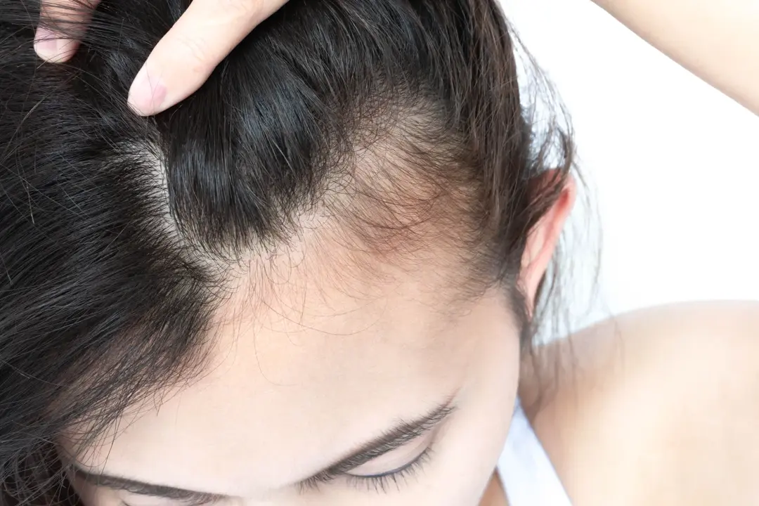 birds eye shot of dark haired woman with thinning hairline